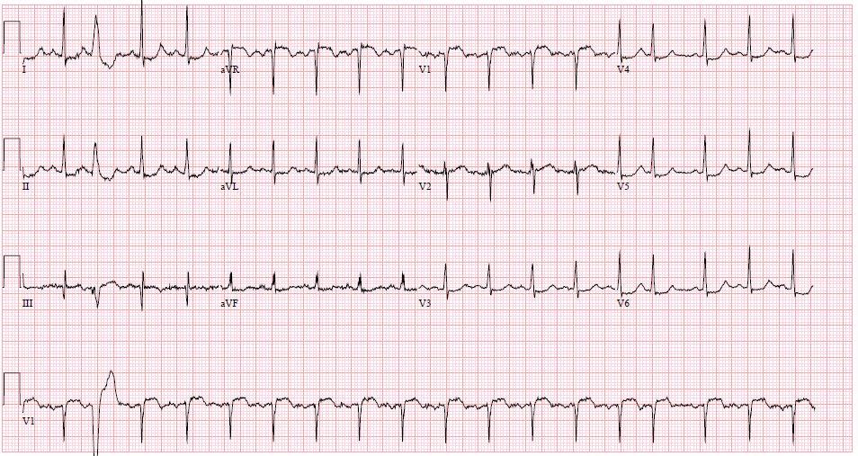 EKG