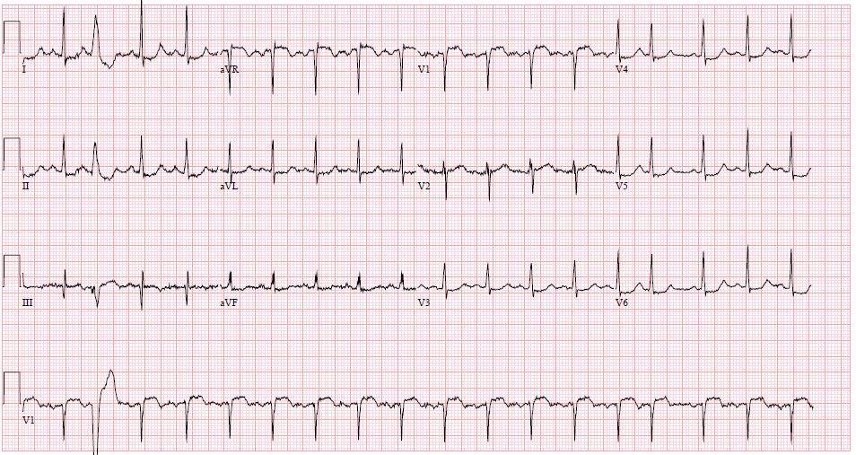 EKG